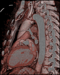 Dilated Ascending Aorta - CTisus CT Scan