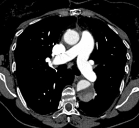 Aortic Dissection Involves Left Renal Aa - CTisus CT Scan