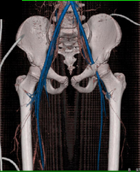 Occlusion of Left External Iliac Aa Due to Trauma - CTisus CT Scan