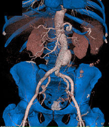 Aortic Aneuryc With Editing Tool - CTisus CT Scan