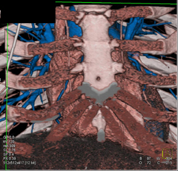 Coronary Arteries Defined Using A Segmentation Tool - CTisus CT Scan