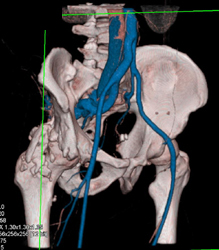 Arteriovenous (AV) Fistulae in Patient With Hx of Trauma - CTisus CT Scan