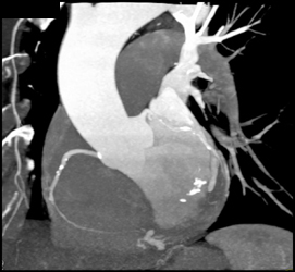 Calcified Plaque in Right Coronary Aa - CTisus CT Scan