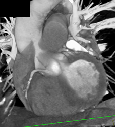 Stent in LAD - CTisus CT Scan