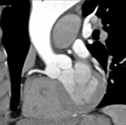 Normal RCA - CTisus CT Scan