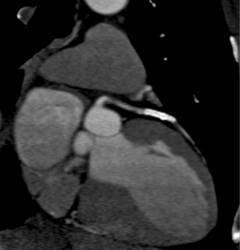 Stent in LAD and It Is Patent - CTisus CT Scan