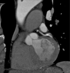 Calcified Plaque in LAD - CTisus CT Scan