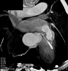 Stent in LAD and Diseased RCA - CTisus CT Scan