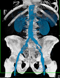 Diseased Left Iliac Artery - CTisus CT Scan