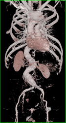 Ectatic Diseased Aorta and Iliac Aas - CTisus CT Scan