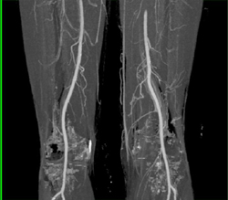 Automated Display of Popliteal Aa - CTisus CT Scan