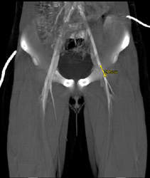 Clot in Superficial Femoral Artery (SFA) Due to Trauma in A Child - CTisus CT Scan