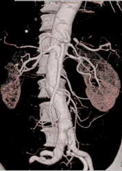 Left Renal Aa Stenosis - CTisus CT Scan