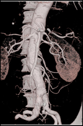 Clot in Superficial Femoral Artery (SFA) Due to Trauma in A Child-MIP Vs VRT - CTisus CT Scan