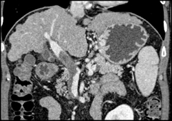 Partial Thrombosis of Portal Vein Well Seen on MPR and VRT But Not on MIP-great Pitfall Case - CTisus CT Scan