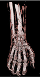 CTA Hand With Bone Removal - CTisus CT Scan