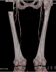 Multiple Stenosis in Superficial Femoral Aas - CTisus CT Scan