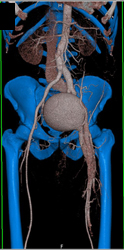 Pelvic Venous Varix S/P GSW Years Earlier. Note Early Draining Into the IVC - CTisus CT Scan