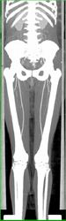 CTA With Automatic Bone Segmentation - CTisus CT Scan