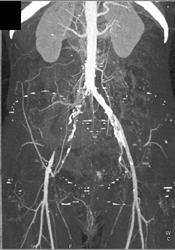 Occlusion of Right Common Iliac Aa - CTisus CT Scan