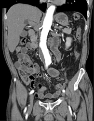 Left Renal Aa Stenosis With Abdominal Aortic Aneurysm (AAA) - CTisus CT Scan