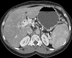 Cavernous Transformation of the Portal Vein (CTPV)-with Collaterals - CTisus CT Scan