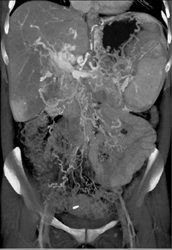 Collaterals Due to Cavernous Transformation of the Portal Vein (CTPV) Well Defined - CTisus CT Scan