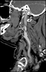 Internal Carotid Aa Stenosis - CTisus CT Scan