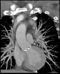 Calcifications in the Aortic Valve - CTisus CT Scan