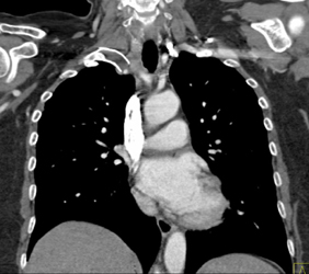 Clotted Stent in Right Subclavian Aa - CTisus CT Scan