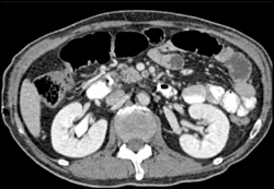 SMA Thrombus - CTisus CT Scan