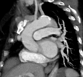 Old Trauma to Arch - CTisus CT Scan