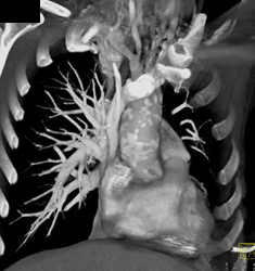 Takayasu's Arteritis - CTisus CT Scan