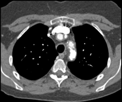 Takayasu's Arteritis - CTisus CT Scan