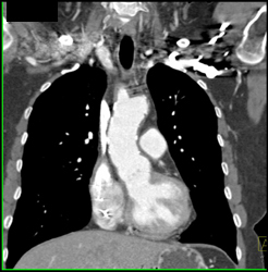 Takayasu's Arteritis - CTisus CT Scan