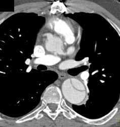 Type B Dissection - CTisus CT Scan