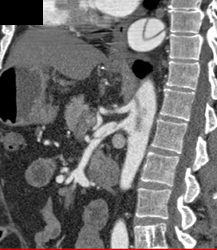 Aortic Dissection Extends Into the SMA - CTisus CT Scan