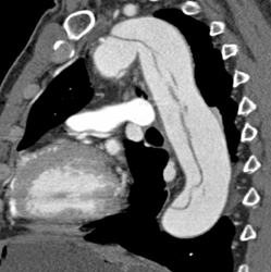 Type B Dissection - CTisus CT Scan