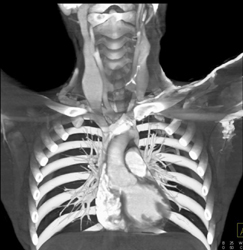 Dilated Jugular Veins in Loeys-Dietz Syndrome - CTisus CT Scan