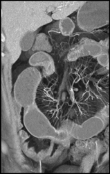 Prominent Vasa Recta in A Patient With Crohn's Disease - CTisus CT Scan