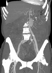 Aorto-femoral Grafts Using VRT and MIP - CTisus CT Scan