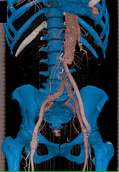 3D Mapping Using Bone Editing to Better Define the Vascular Grafting Including A Fem-fem Graft - CTisus CT Scan