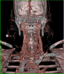 Carotid Aa Stenosis - CTisus CT Scan