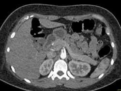 SMA and Celiac Arise Directly Off the Aorta - CTisus CT Scan