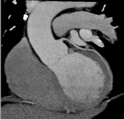 Normal Coronary Arteries - CTisus CT Scan