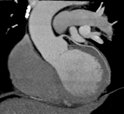 Normal Coronary Arteries - CTisus CT Scan