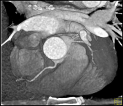 Normal Coronary Arteries - CTisus CT Scan