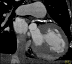 Multiples Plaques in LAD - CTisus CT Scan