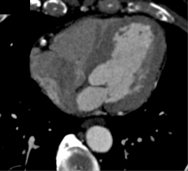 Plaque in RCA - CTisus CT Scan