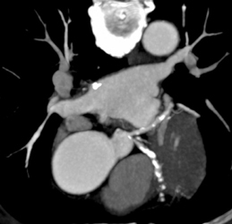 Diseased LAD and Circumflex - CTisus CT Scan